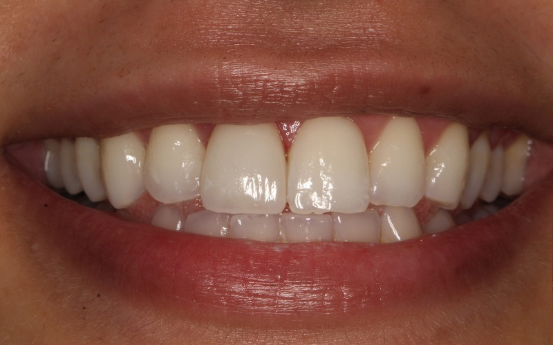 Veneers in Manchester